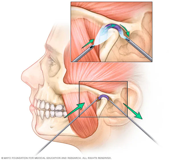 Individual performing jaw relaxation exercises to alleviate TMJ discomfort
